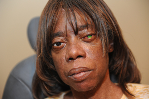 Rita Coffee developed an infectious corneal ulcer caused by her non-prescription contact lenses. (Photo by Joe Howell)