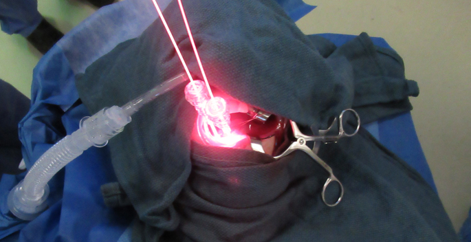 Twenty-four hours after the administration of the study drug, catheters are inserted into the tumor and lasers emitting a wavelength of light that activates the dye molecule on the ASP-1929 are illuminated.