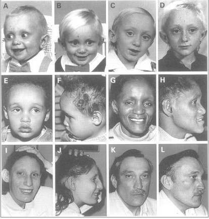 Images of individuals with Alagille syndrome (National Institutes of Health)