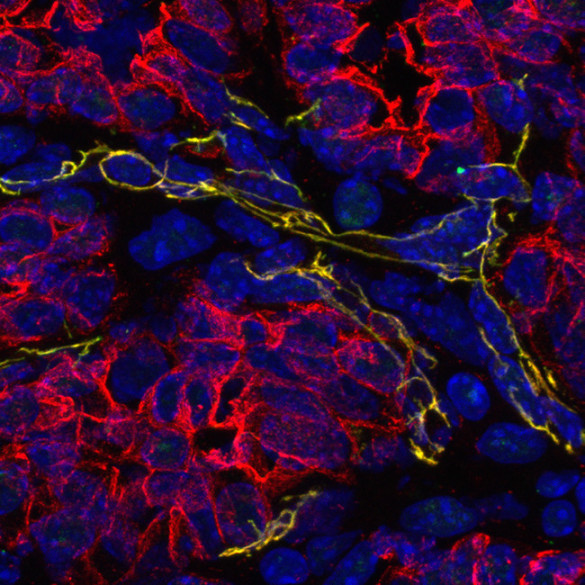 Image of a mammary tumor stained for cell nuclei (in blue), blood vessels (in green) and the protein beta-catenin that causes cells to stick together (in red) (Reinhart-King Lab / Vanderbilt)