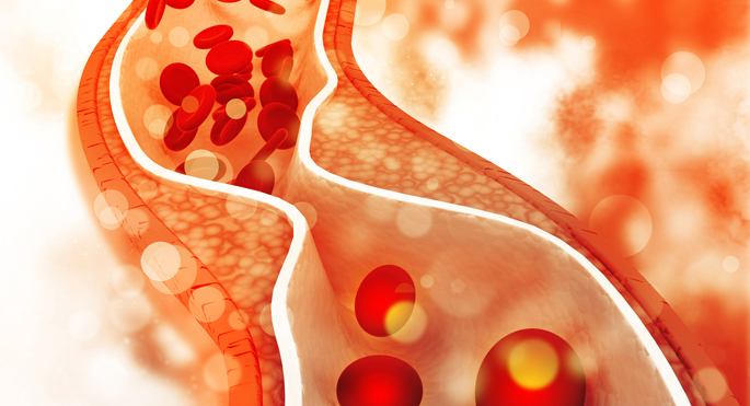 The study could suggest ways to promote the transport of phospholipids and cholesterol out of macrophages, immune system cells that play key roles in all stages of atherosclerosis development.