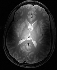 Brain image obtained by the new 7 Tesla MRI scanner at the Vanderbilt University Institute of Imaging Science shows a transaxial cross section through the brain of a healthy volunteer. 
Image courtesy of John Gore, Ph.D.