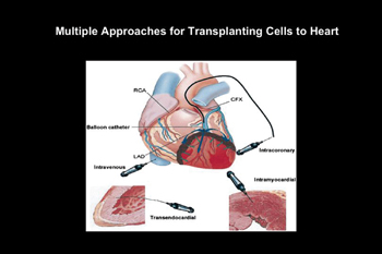 Advanced treatment options, including the use of stem-cell based therapies, have proven to restore injured and/or lost cardiac tissue to improve heart function. 