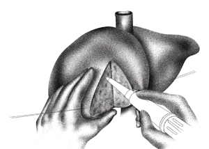 Living-donor liver transplantation involves removing, or resecting, a portion of a healthy donor’s liver and transplanting it to the patient.
Illustration by Dominic Doyle