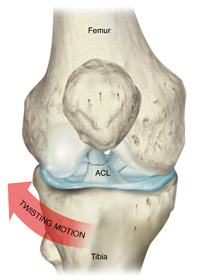 This illustration shows the location of the anterior cruciate ligament (ACL) and how it can be injured. (illustration by Medical Art Group)