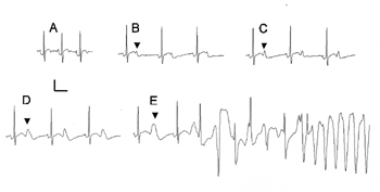 Representative ECG tracings showing evolution of U-wave amplitude before intiation of TdP in drug-induced arrhythmia in rabbit. (A) Baseline before infusion of drug. (B) ECG tracing 12 minutes after drug infusion shows emergence of a U wave (marked by arrowhead in this and subsequent panels). C and D show progressive increase in U wave amplitude 2 min (C) and 10s (D) before TdP initiation. (E) U-wave amplification increases further and is associated with premature beats and TdP. Scale bar is 10 mV (vertical) and 200 ms (horizontal) throughout.