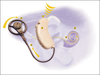 How cochlear implants work: 1. Sound is received by the microphone. 2. The sound is analyzed and digitized into coded signals by an internal chip. 3. Coded signals are sent to the transmitter. 4. The transmitter sends the code across the skin to the receiver where it is converted to electronic signals. 5. Signals are sent to the electrode array in the cochlea to stimulate the hearing fibers. 6. Signals travel to the brain where they are recognized as sounds, producing a hearing sensation. (courtesy Cochlear Corp.)