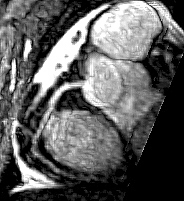 Coronary MRA of the right coronary artery.