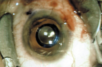 The implantable miniature telescope shows in the pupil of Torgersen’s eye.
