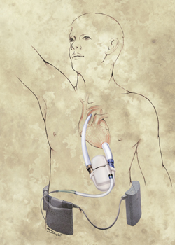 An illustration of the LVAD device similar to the one implanted in Riley. (illustration by Dominic Doyle)