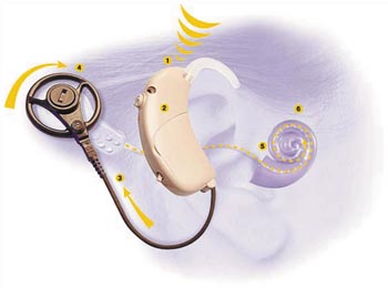 How cochlear implants work: 1. Sound is received by the microphone. 2. The sound is analyzed and digitized into coded signals by an internal chip. 3. Coded signals are sent to the transmitter. 4. The transmitter sends the code across the skin to the receiver where it is converted to electronic signals. 5. Signals are sent to the electrode array in the cochlea to stimulate the hearing fibers. 6. Signals travel to the brain where they are recognized as sounds, producing a hearing sensation. (Courtesy Cochlear Corp.)
