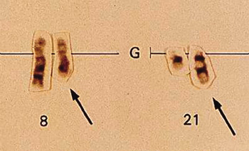 t(8;21) reciprocal chromosomal translocation. A piece of chromosome 8 has broken off and attached to chromosome 21, and vice-versa. (Medicine OnlineTM)