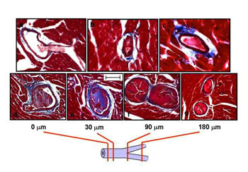 Examples (A-C) of coronary arterial thromboses, or clots, in transgenic mice that overexpress a stable form of PAI-1. Panels D-G depict cross sections along a thrombosed coronary artery, as schematically illustrated below the images. The clotting extends the length of the main artery and into each of the branching vessels.
